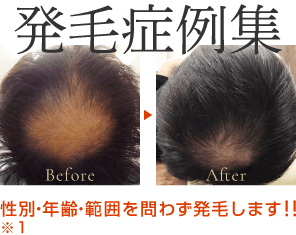 発毛症例集:性別・年齢・範囲を問わず発毛します!!