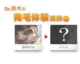 Dr鈴木の発毛体験実例